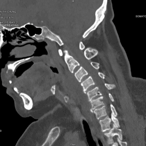Nhiễm trùng cột sống
