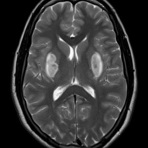 Ngộ độc rượu