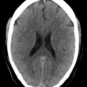 Ngộ độc Metronidazol