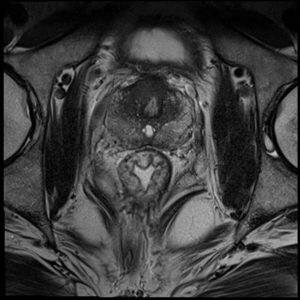 Ung thư tiền liệt tuyến