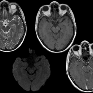 Di căn màng cứng
