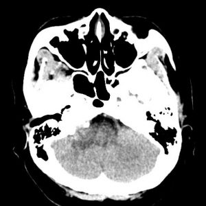 Schwannoma