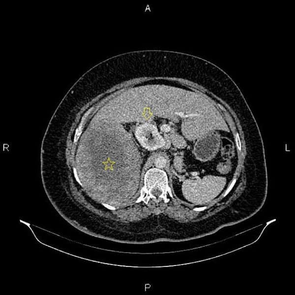 Sarcoma sau phúc mạc đè đẩy thận phải và đại tràng lên