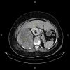 Sarcoma sau phúc mạc đè đẩy thận phải và đại tràng lên