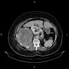 Sarcoma sau phúc mạc đè đẩy thận phải và đại tràng lên