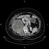 Sarcoma sau phúc mạc đè đẩy thận phải và đại tràng lên