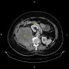 Sarcoma sau phúc mạc đè đẩy thận phải và đại tràng lên