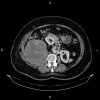 Sarcoma sau phúc mạc đè đẩy thận phải và đại tràng lên