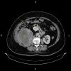 Sarcoma sau phúc mạc đè đẩy thận phải và đại tràng lên