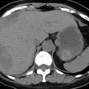 Tụ máu dưới bao gan