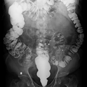 Túi thừa đại tràng