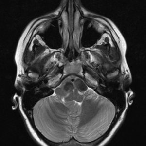 Nang thần kinh ruột