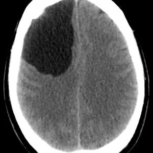 Nang thần kinh ruột