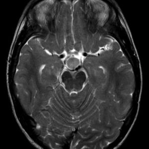 Hamartoma dưới đồi