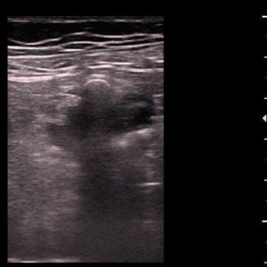 Túi thừa đại tràng