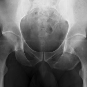 Đảo xương lành