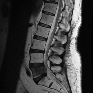 Di căn cột sống