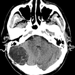 U nang bì ngoài màng cứng