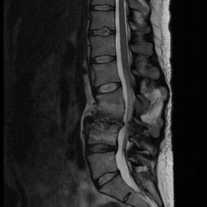 Nhiễm trùng cột sống