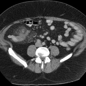 Viêm gốc ruột thừa