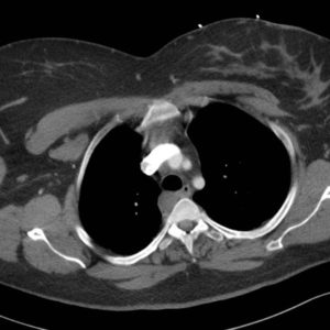 Nang thực quản đôi