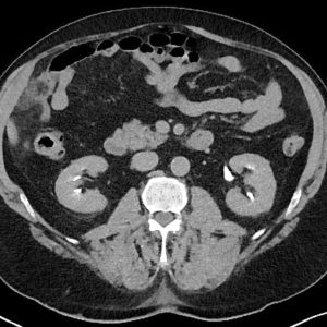 Nhồi máu mạc nối