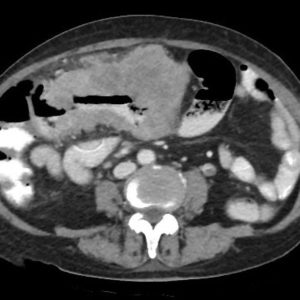 GIST đại tràng ngang