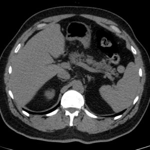 Bất sản túi mật
