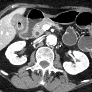 Tắc ruột sỏi mật