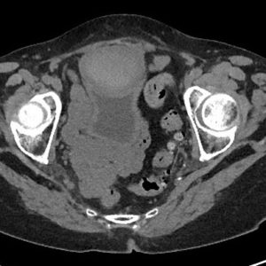 Tụ máu ngoài phúc mạc