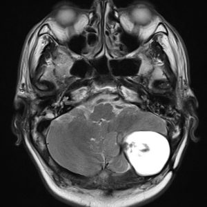 U nang bì nội sọ