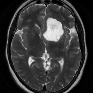 U nang bì nội sọ