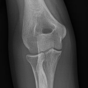 Chấn thương khuỷu tay