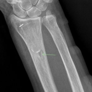 Chấn thương cẳng tay