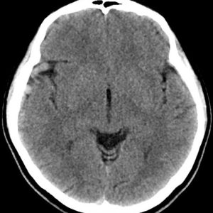 Thông động tĩnh mạch não