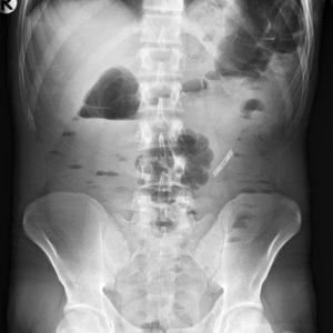 Dị vật ống tiêu hóa