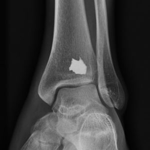 Dị vật phần mềm