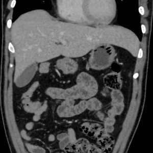 Túi thừa túi mật