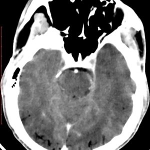 Thuyên tắc khí não