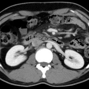 Viêm mỡ mạc treo
