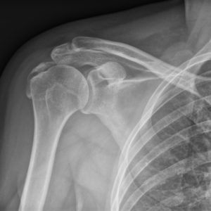 Viêm gân cơ trên gai