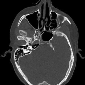 Trật khớp thái dương hàm