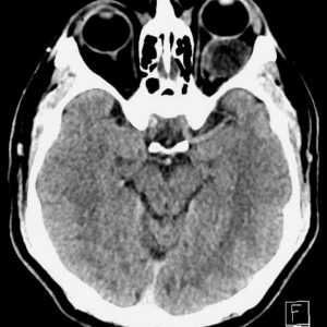 U dây thần kinh thị giác