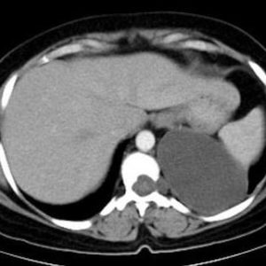 Thoát vị màng tủy