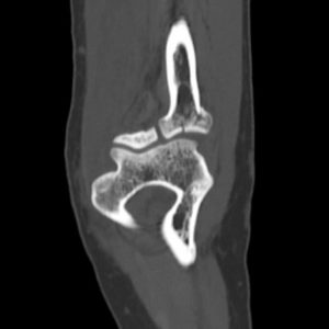 Chấn thương khuỷu tay