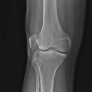 Chấn thương khớp gối