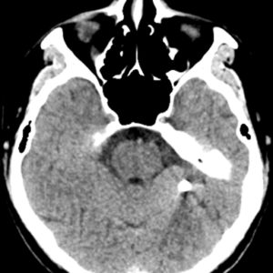 Dị vật nội sọ