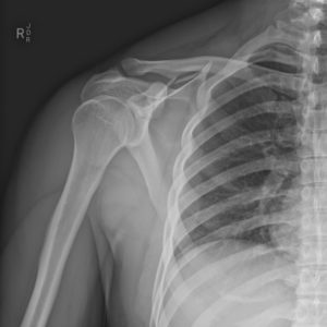 Chấn thương khớp vai