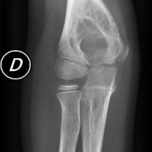 Nang xương phình mạch