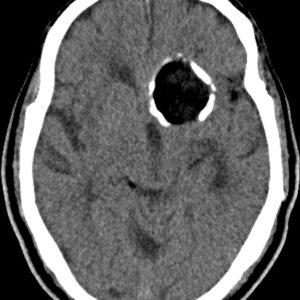 U nang bì nội sọ